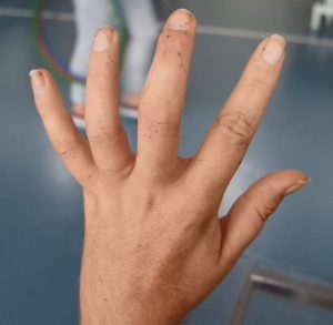 Medical Taping - MS - Finger ohne Tape