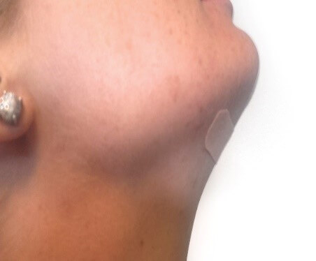medical taping erhöhten Speichelfluss