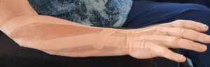 medical taping - ms mit Tape Funktion Verbesserung der Hand