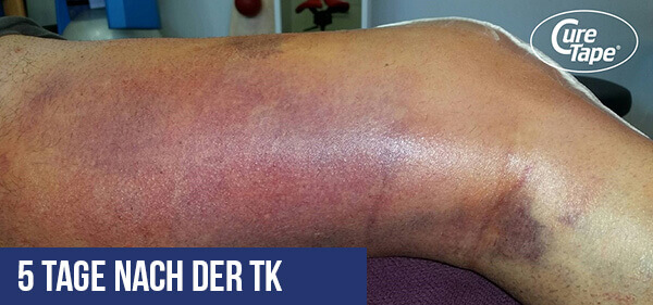 me5 tage nach der knie totalprothese